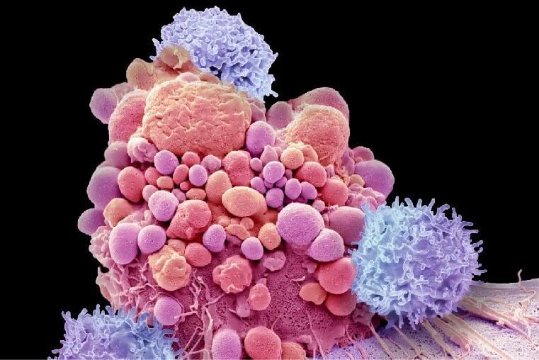 T-cells attaching brain cancer cell