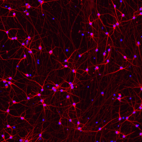 Human iPSC-derived Parkinson's disease model